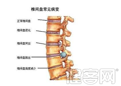 腰椎骨質分類