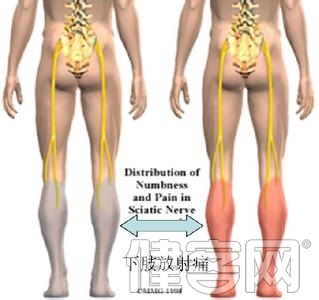 患有腰椎間盤突出有哪些臨床表現