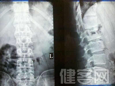 腰肌勞損的症狀和病因是什麼呢