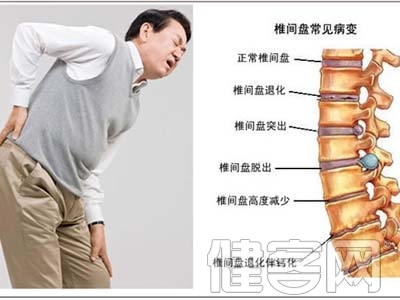 腰痛伴腿痛95%是腰椎間盤突出