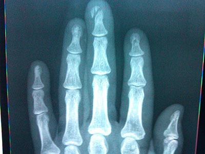 幾種常見的手部骨折的症狀表現