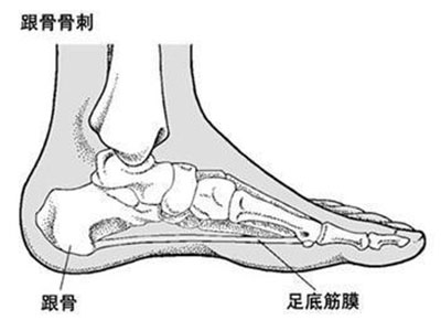 腳跟骨刺有什麼症狀？
