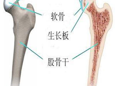 股骨頭壞死會出現的症狀