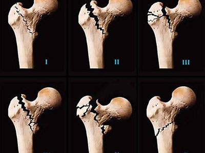 蓋氏骨折的症狀分型