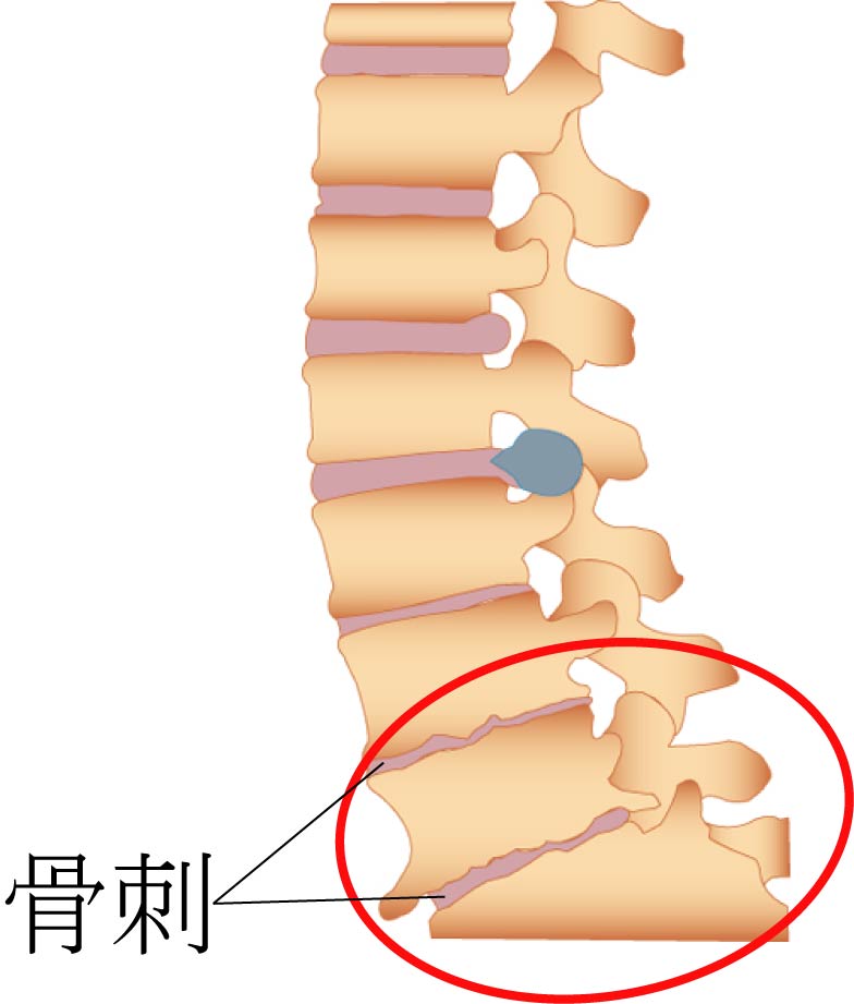 骨質增生有哪些症