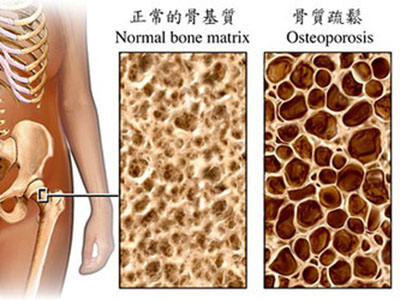 腰背疼、身高變矮 應懷疑患了骨質疏松