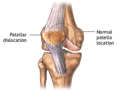 走路膝蓋發軟或是髌骨軟化
