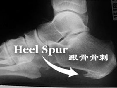 腳後跟總是痛 當心犯上“跟痛症”