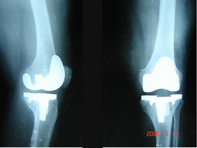桡骨遠端骨折有什麼臨床表現？