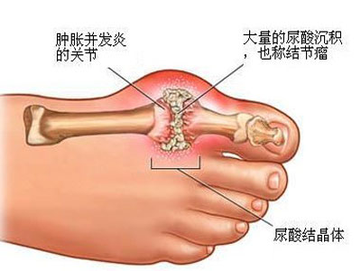 請問什麼是痛風？