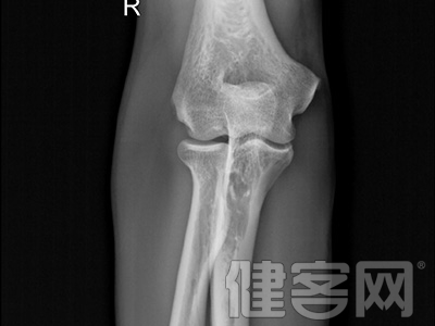 局限性骨髓炎有哪些診斷方法