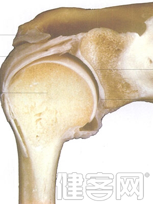 股骨頭壞死的分期症狀有哪些？