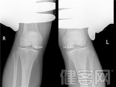 膝蓋滑膜炎的症狀與診斷