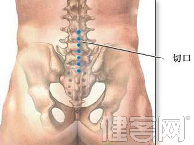 需要大家特別注意的腰椎間盤突出的臨床表現
