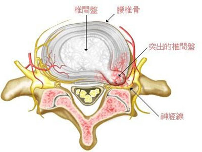 健康解答:為什麼會腰痛？