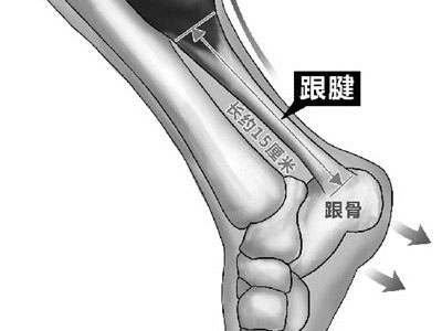 患上跟腱炎的原因是什麼？