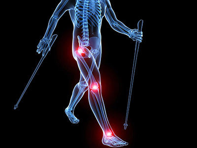 膝關節腫脹的常見原因