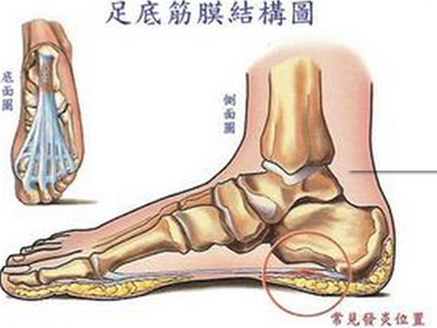 腳底疼痛可能是腳底筋膜炎