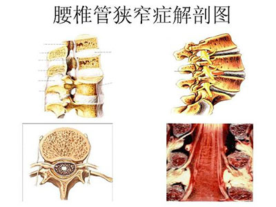 哪些因素可誘發腰椎管狹窄？