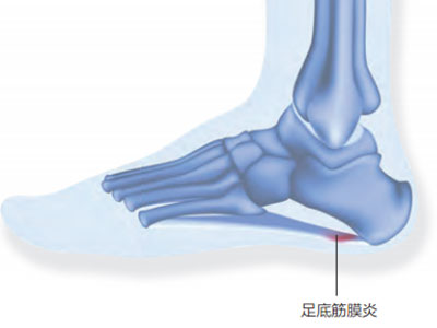 為何中老年易出現足跟痛？