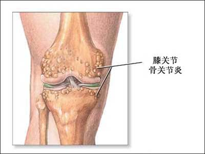 膝關節疼痛找准病因對症治療