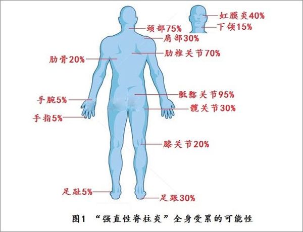 哪些因素導致強脊