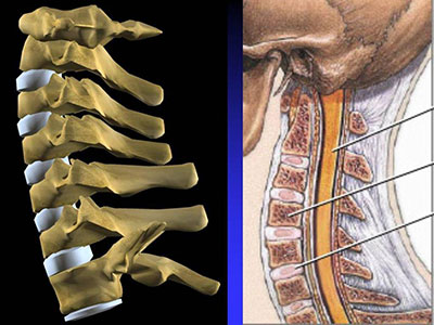 脊柱側凸的幾個病理因素