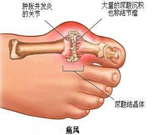 最常見的引起痛風的原因