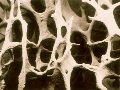 患骨質疏松是什麼原因
