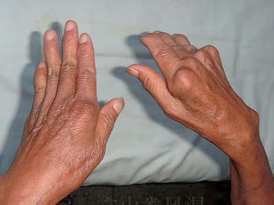 早起手腕、手指關節僵硬是什麼問題？