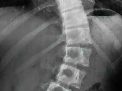 哪些因素導致脊柱畸形