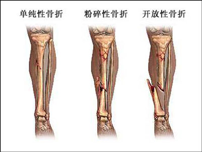膝關節骨質增生產生的原因
