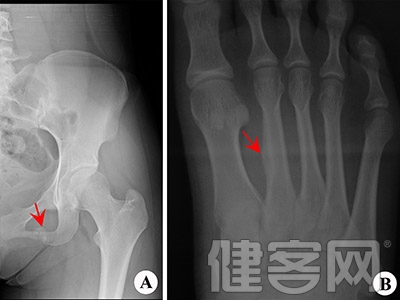 痛風疼痛的病因分析