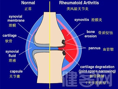 膝關節滑膜炎是怎麼回事