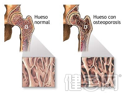 坐著也會骨折 病在骨質疏松