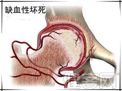 中醫解釋的股骨頭壞死發病原因