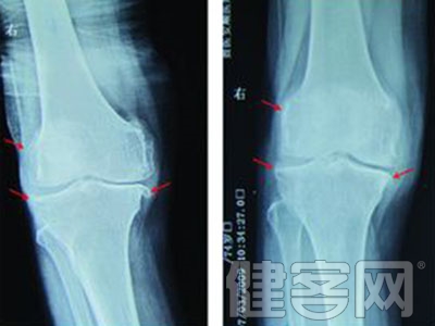 膝關節為何容易骨質增生