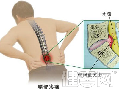 腰椎間盤突出是由什麼原因引起的？