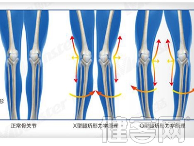淺析誘發O型腿的幾大因素