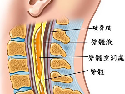 別把脊髓空洞症當成了頸椎病