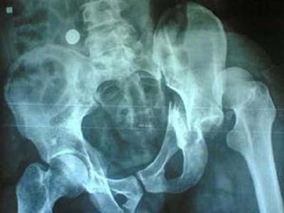 了解股骨頭壞死的治療誤區有哪些