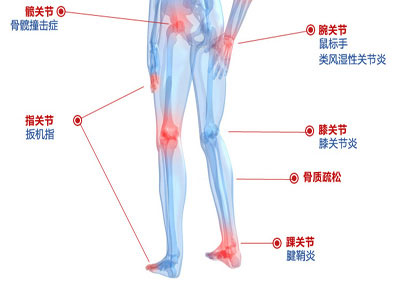 對於骨結核誤區 你知道多少？