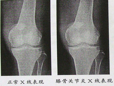 理性認識小心進入骨關節炎誤區