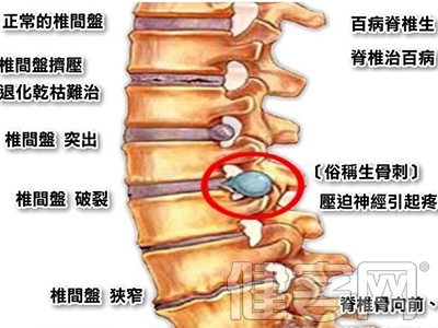 專家解讀骨刺治療的各種誤區