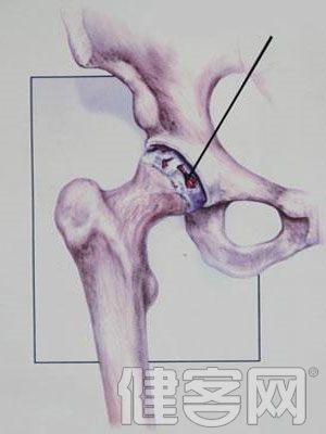 股骨頭壞死應當如何去選擇飲食