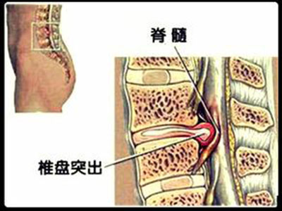 腰椎間盤突出症預防和康復