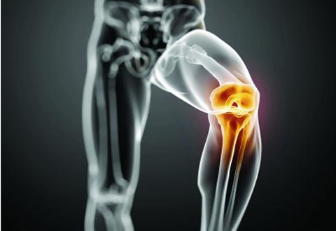 膝關節炎患者的10點防治建議