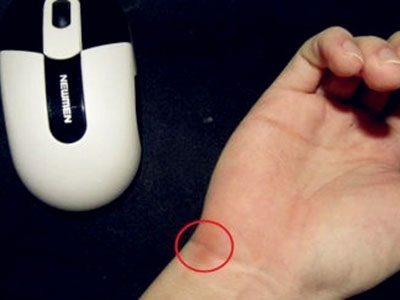 “鼠標手”是神經退變 做手指操可預防