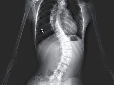 脊柱側彎的X線檢查方法