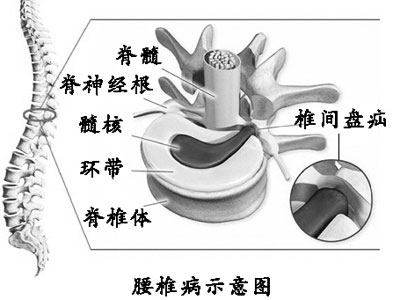 如何自我診斷腰椎間盤突出?